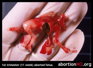 Débat sur le crime d'avortement - Page 3 Fetus08